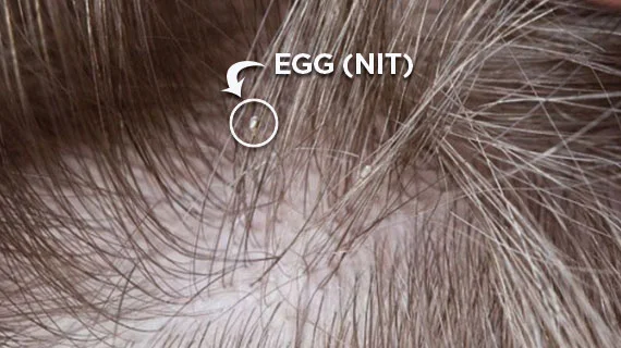 A nit is a lice egg.